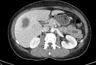 liver Unique 2/3 > multiple abcesses