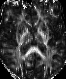 A Multimodal Imaging Study of Subcortical Gray Matter