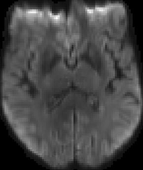weighted imaging (DWI) 1 Subcortical gray matter: FA =