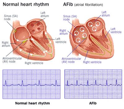Atrial Fibrillation Most common heart rhythm disturbance Rapid and irregular