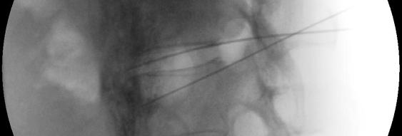 aorta on the right Radiofrequency has been described