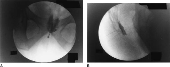 Fluoroscopy: lateral fluoro view visualize the sacrococcygeal junction 20 or 22-gauge needle advanced