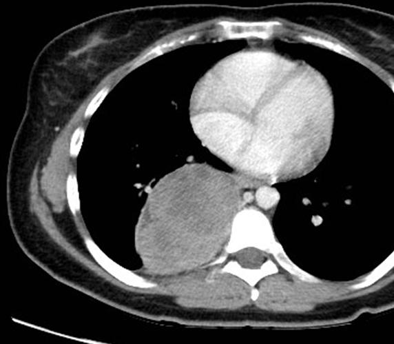 15-25%), predominantly located in the posterior mediastinum Chest wall one of the more usual chest wall tumors characterized by pressure deformity and displacement of the adjacent