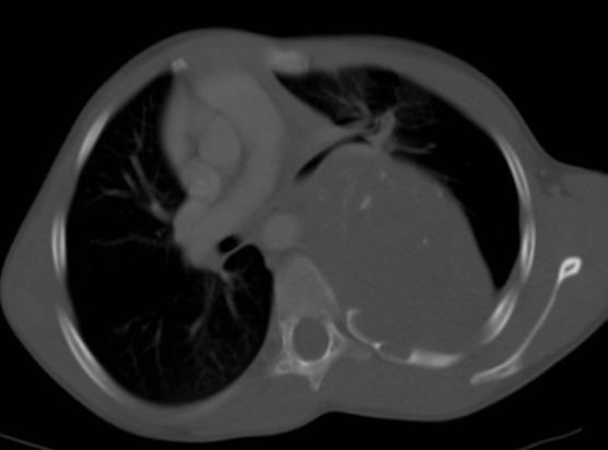 GANGLIONEUROMA CT FINDINGS 7 year old with a ganglioneuroma.