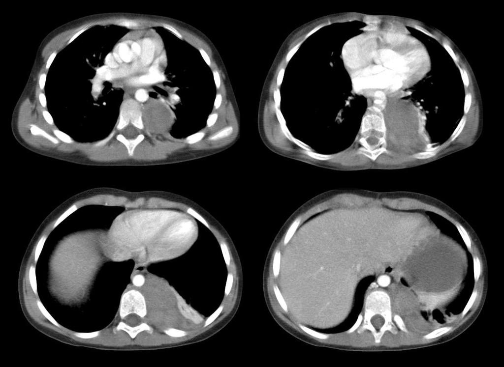 GANGLION TUMORS Ganglioneuroblastoma Intermediate tumor between ganglioneuroma and neuroblastoma Variable imaging characteristics on a spectrum ranging from a similar appearance to ganglioneuroma à