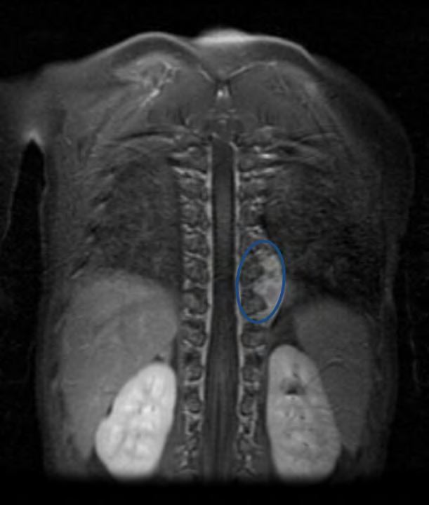 T2 hyperintense signal posterior mediastinal mass