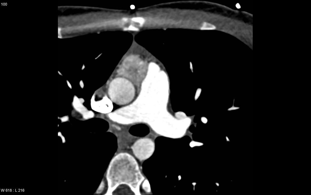 or from autonomic tissue along the paravertebral sulci Tumors often hypervascular on imaging and demonstrate central necrosis and hemorrhage Coronal contrast-enhanced CT of a