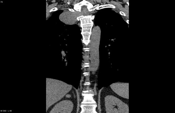 SCHWANNOMA CT FINDINGS Axial and coronal non-contrast CT images demonstrate expansion of the T2 neuroforamen and erosion of the T2 vertebral body by a smoothly marginated mass in this patient with