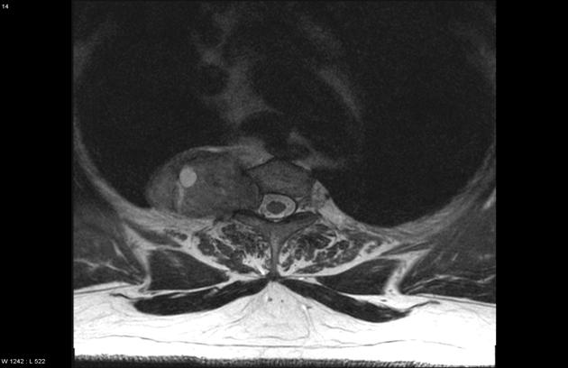 T1 post-gadolinium MR image of this same patient with schwannoma demonstrate characteristic neuroforaminal expansion, vertebral body erosion, and avid enhancement.