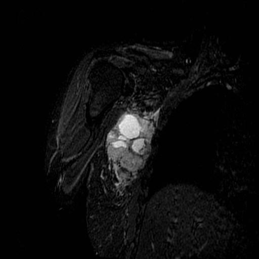 MALIGNANT PERIPHERAL NERVE SHEATH TUMOR MRI