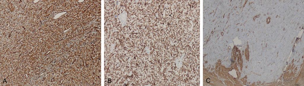 Figure 2. Immunohistochemistry of the ESS. A. Diffuse, positive expression of Vimentin; B. Diffuse, positive expression of CD10; C.