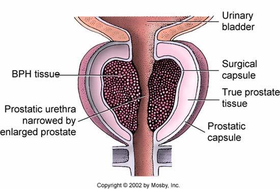 Benign Prostate