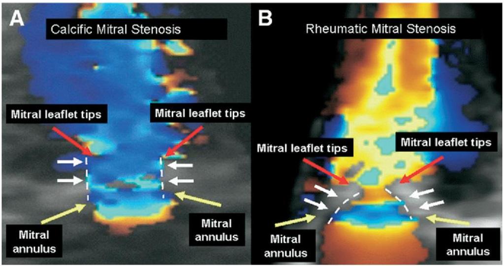 Real-time 3D transthoracic echocardiography