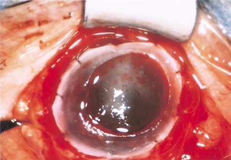 Panel C shows the condition of the ocular surface 17 months after surgery (the condition of the eye had not changed at the patient s latest visit, 0 months after surgery). >30 mg per deciliter [10.