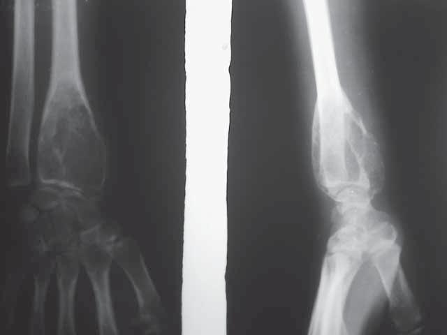 902 Fig. 1a. Fig. 1b. Fig. 1c. Fig. 1d. Fig. 1. (a) and (b) Plain X-rays at presentation showing recurrence after curettage and bone cement.