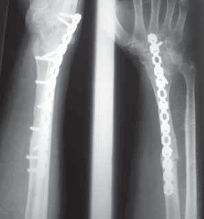 Reconstruction with corticocancellous iliac or centralisation of ulna sacrifices the wrist and forearm motion. Nearly half of these grafts suffer stress fracture.