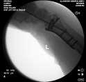 ORIF 4 weeks postop Lunate Facet Fragment Fixation can be