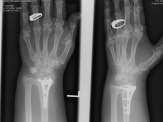 D. Corrective osteotomy for isolated malunion of the palmar lunate