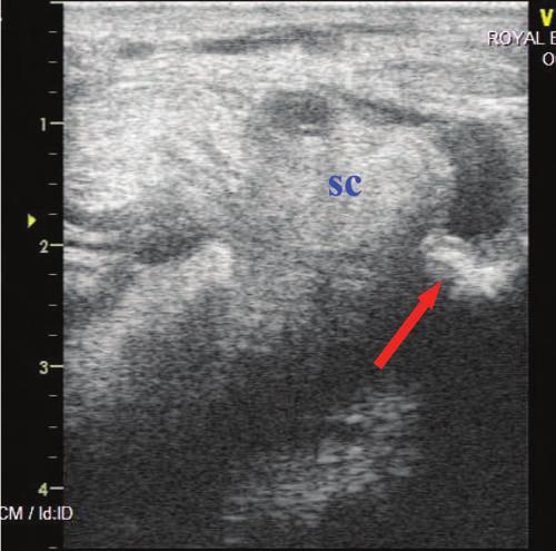 Fig. 4. Transverse image of an exostosis impinging on the superior check ligament in a 2-yr-old Thoroughbred filly with recurrent effusion in the carpal sheath. Dorsal is to the right.