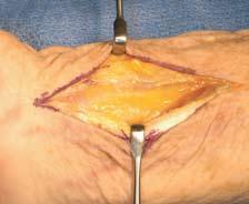 Operative Technique Anatomical Volar Plate 1. An incision is made approximately 8cm long just radial to the FCR tendon.