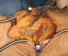 The FCR tendon is retracted ulnarly and dissection is carried down through the floor of the FCR sheath.