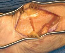 The FCR tendon is retracted ulnarly and dissection is carried down through the floor of
