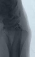 The use of AP/Lat fluoroscopy is helpful to determine correct fracture reduction and