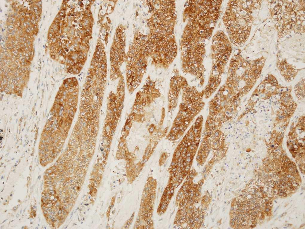 Page of 0 0 0 Supplementary Figure : Immunohistochemical staining of NSCLC samples.