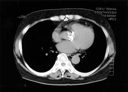 Sezai et al. Fig. 3. Chest CT before the surgery. cidence of thromboembolic event was 1.5%/patient-year, that of paravalvular leakage was 1.1%/patient-year, that of bleeding was 1.