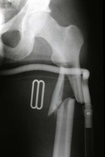 MULTIFRAGMENTARY PROXIMAL- THIRD FEMORAL FRACTURE