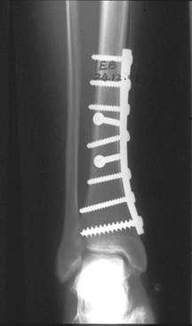 Direct bone healing the response to rigid fixation Temporary acceleration of Haversian remodelling Only