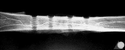 Effect of implants on bone biology