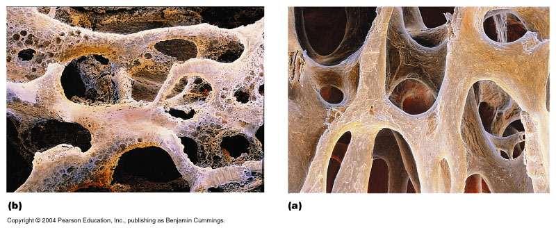 Osteoporosis Affects elderly, especially women Bone resorption proceeds faster than deposition Low estrogen levels implicated but