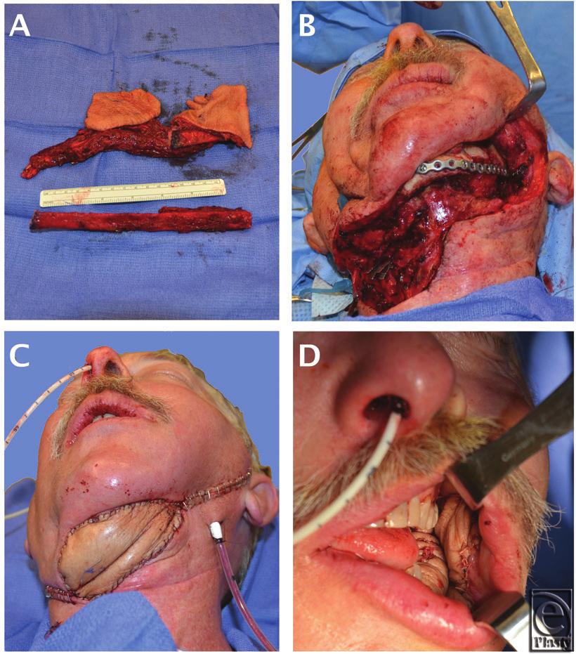 eplasty VOLUME 13 Figure 1. (a) Double skin paddle fibula free flap freed from fibula. (b) Dissection showing lateral mandibular and submental defect. (c) Flap inset into submental defect.