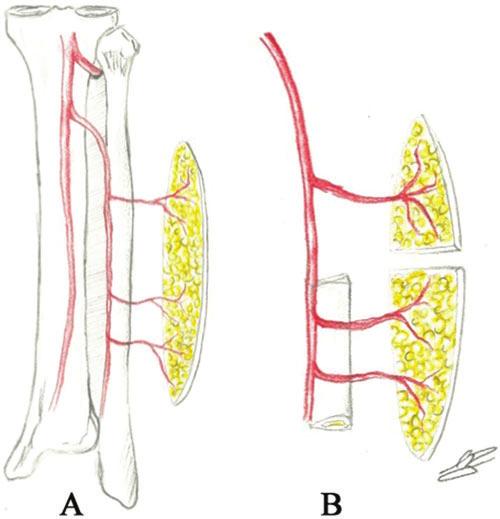 BADEAU AND DELEYIANNIS demonstrated an average of 4.8 cutaneous peroneal perforators per leg with 66% of these being septocutaneous perforators and 34% musculocutaneous.