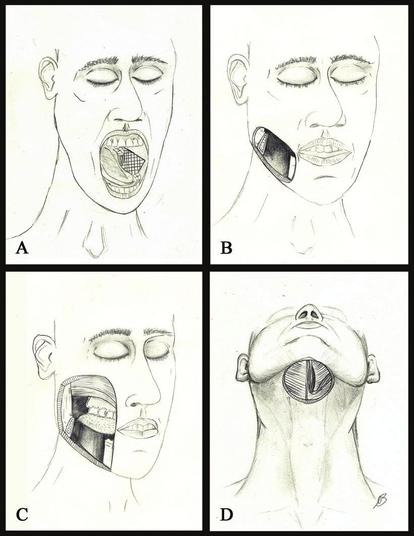 BADEAU AND DELEYIANNIS Figure 3. (a) Type 1 defect with resection limited to the lateral mandible and soft tissue of the oral cavity (i.e., floor of mouth, lateral tongue).