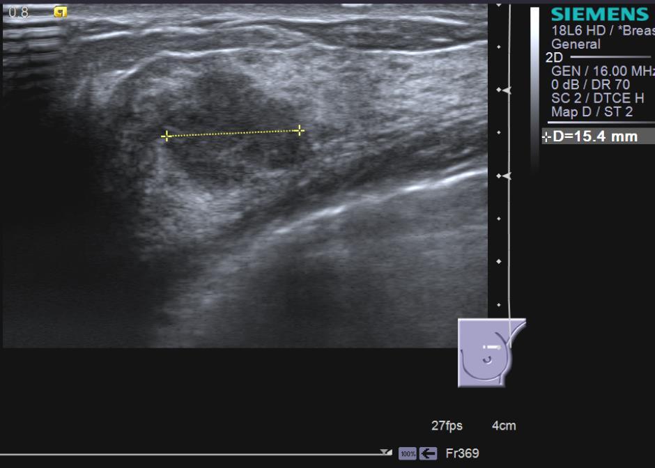 Case 1 30 Y F presents with a benign-feeling mass in the left breast (P3) Ultrasound performed