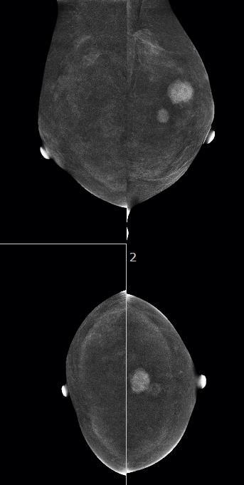 Recombined Imaging The recently biopsied tumour in the left upper midline is seen as an enhancing mass measuring 21 mm.