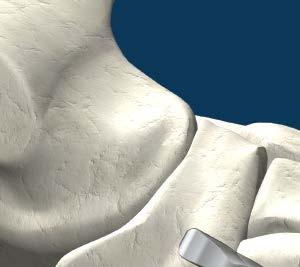Naviculocuneiform (NC) Joint Arthrodesis Fusion of the navicular bone