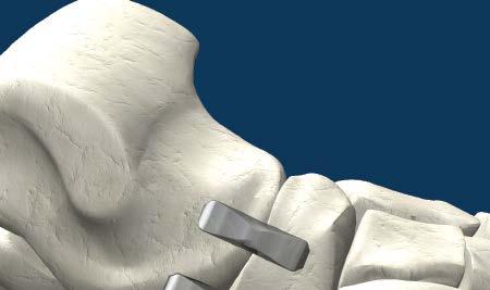 Talonavicular (TN) Joint Arthrodesis Fusion of the navicular bone to the talus.