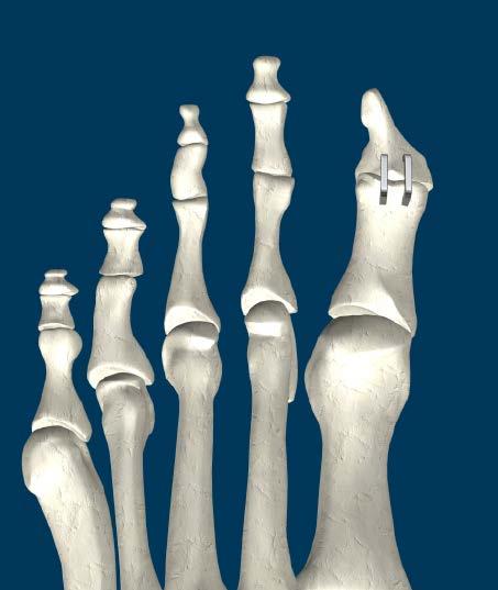 Hallux Interphalangeal (IP) Joint Arthrodesis Fusion of the distal and proximal phalanges of the Hallux.
