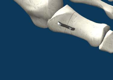 If placement is proximal or distal medially along the proximal or distal metaphyseal flare, use a SPEEDARC Memory Implant.