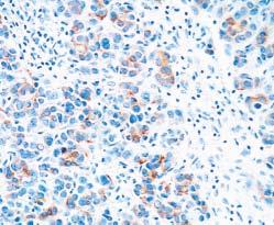 B, HCC positive for cytokeratin (CK) 7 in a 3+/3+ manner;