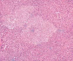 Klein et al / PRIMARY LIVER CARCINOMA Despite the lack of chronic hepatitis and fibrosis, the background nonneoplastic liver samples showed discrete FAH in 1 of the 7 HCC cases, 1 of 3 FLC cases, and