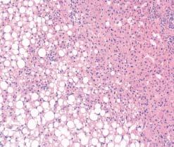 FAH were microscopically of 2 types: The first (found in the cholangiocarcinoma case) showed large, pale hepatocytes without fatty change Image 2A, essentially identical to those described by Su et