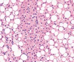 The second (found in the HCC and FLC cases) was characterized by circumscribed, nodular foci of smaller hepatocytes with an increased nuclear/cytoplasmic ratio, fatty change, and occasional