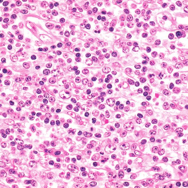 e spleen shows in ltration with small lymphoid cells as well as with larger immunoblast-like cells (arrows, H&E, 400x). TABLE 2: Detected mutations in CD79A, CD79B, CARD11, and MYD88.