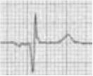 1.1.2 Background Information on Monitored Heart Conditions To perform automatic detection of an ECG signal, there needs to be something that clearly delineates a certain abnormality from other signals.