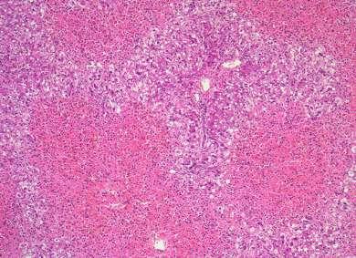 Paracetamol-associated liver injury micropathology Centroacinar necrosis is the hallmark of liver pathology This localization is explained by the fact that