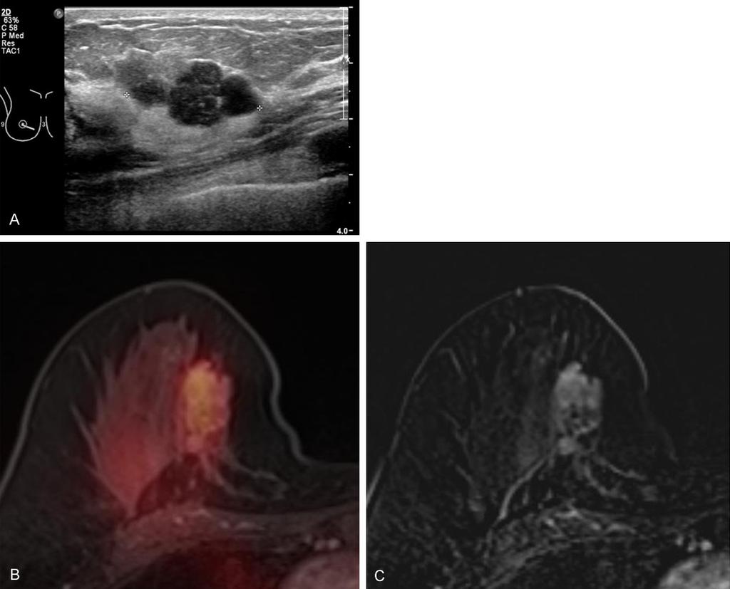 Figure 1. (A) Breast ultrasonography showed a multilobulating mixed hypoechoic and isoechoic mass measuring 2.9 cm in size at the periareolar area.
